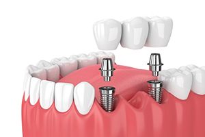 Illustration of implant bridge for lower dental arch