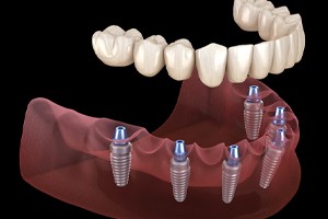 Implant denture for lower arch, secured on six dental implants