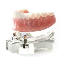 Model dental implant supported denture placement