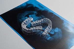 Two Invisalign aligners sitting on top of X-ray