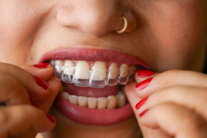 Close-up of woman placing Invisalign aligner on her teeth