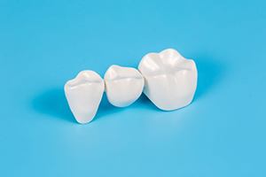 Three-unit dental bridge against blue background