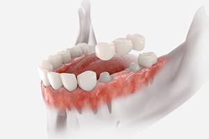 Illustration of traditional bridge being placed on abutment teeth