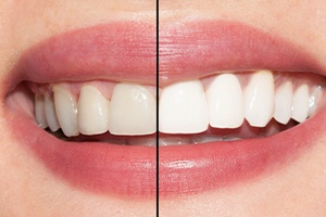 Smile before and after teeth whitening