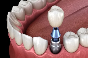 Dental implant, abutment, and crown being placed in mouth