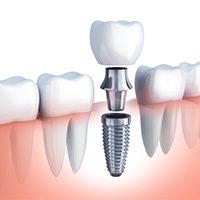 Animated dental implant supported dental crown placement