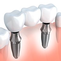 Animated dental implant supported fixed bridge placement