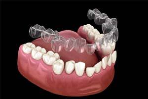 Illustration of Invisalign® being placed on crooked teeth