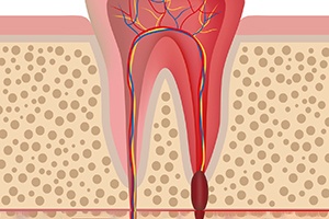 Illustration of damaged tooth that may need root canal therapy