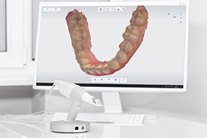 Digital smile impressions on computer screen