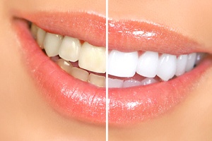 Close-up of woman’s smile before and after teeth whitening