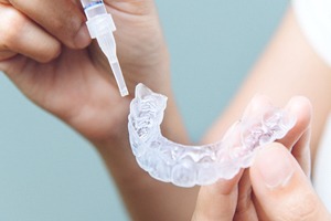 Carefully placing whitening gel in custom teeth tray