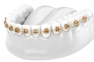 Illustration of teeth connected by brackets and archwire