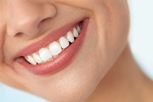 Closeup of gorgeous smile after porcelain veneers
