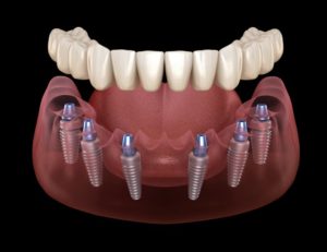 Implant denture in East Hartford, secured by six implants