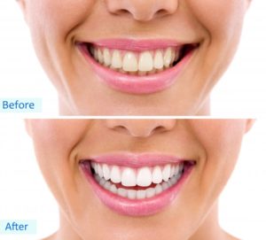 Woman’s teeth before and after teeth whitening in East Hartford