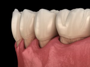 Close-up of receding gums in East Hartford