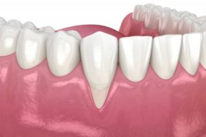 Illustration of receding gums, may need gum recontouring