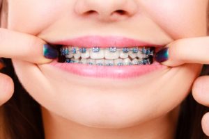 Close-up of girl’s smile with traditional braces in East Hartford