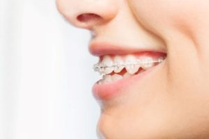 Side view of woman’s smile with braces