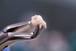 Extracted tooth gripped in dental forceps 
